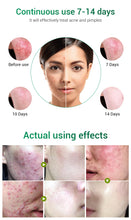Load image into Gallery viewer, BREYLEE Acne Removal Pimple Patch Stickers Face Mask Skin Care Acne Treatment Serum Face Cream Acne Cream Essence Fast Absorbed
