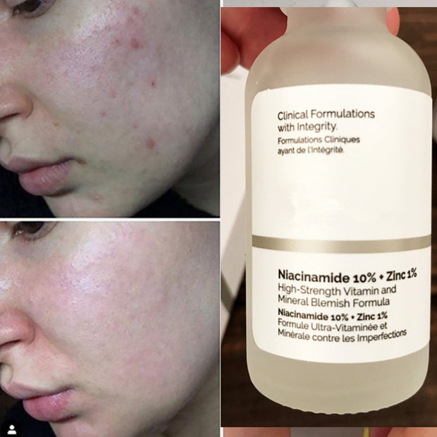 Ordinary Niacinamide 10% + Zinc1% Improve Skin Imperfectio Repair Red Skin And Brighten Skin Oil Control Shrink Pores Even Skin